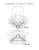 DEVICE AND METHOD FOR CORRECTING A SPINAL DEFORMITY diagram and image