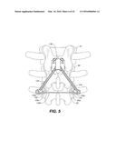 DEVICE AND METHOD FOR CORRECTING A SPINAL DEFORMITY diagram and image