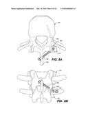 DEVICE AND METHOD FOR CORRECTING A SPINAL DEFORMITY diagram and image