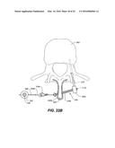 DEVICE AND METHOD FOR CORRECTING A SPINAL DEFORMITY diagram and image