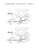 DEVICE AND METHOD FOR CORRECTING A SPINAL DEFORMITY diagram and image