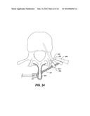 DEVICE AND METHOD FOR CORRECTING A SPINAL DEFORMITY diagram and image