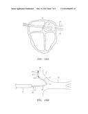 PRESHAPED ABLATION CATHETER FOR ABLATING PULMONARY VEIN OSTIA WITHIN THE     HEART diagram and image