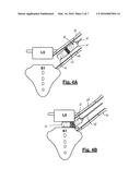 Spinal Surgical Implant and Related Methods diagram and image