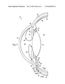 DEVICES, SYSTEMS AND METHODS FOR POSTERIOR SEGMENT DRAINAGE diagram and image