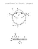 DEVICES, SYSTEMS AND METHODS FOR POSTERIOR SEGMENT DRAINAGE diagram and image