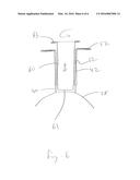 TREPHINE GUIDE diagram and image