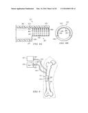 SYSTEM FOR PERCUTANEOUSLY ADMINISTERING REDUCED PRESSURE TREATMENT USING     BALLOON DISSECTION diagram and image