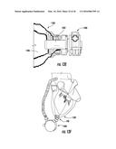 Devices, Systems, and Methods for Implanting and Using a Connector in a     Tissue Wall diagram and image