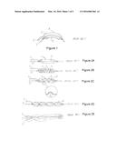 Controlled Burst Flexible Medical Balloon with Axially Constant Radial     Pressure diagram and image