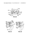 Methods and Devices for Locating and Adjusting an Implantable Valve diagram and image