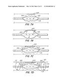 Clearance of Sinus Ostia Blockage diagram and image