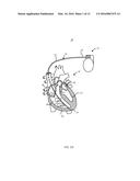 IMPLANTABLE MEDICAL LEADS HAVING OSCILLATING CABLE CONDUCTOR LUMENS diagram and image