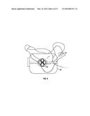 METHODS AND DEVICES FOR TREATING MIGRAINES WITH ELECTROMAGNETIC     STIMULATION diagram and image