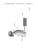 METHODS AND DEVICES FOR TREATING MIGRAINES WITH ELECTROMAGNETIC     STIMULATION diagram and image