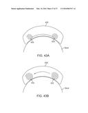 METHODS AND DEVICES FOR TREATING MIGRAINES WITH ELECTROMAGNETIC     STIMULATION diagram and image