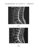 MEASURE OF DISC DEGENERATION AND PATHOLOGY diagram and image