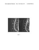 MEASURE OF DISC DEGENERATION AND PATHOLOGY diagram and image