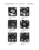 MEASURE OF DISC DEGENERATION AND PATHOLOGY diagram and image