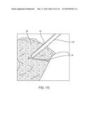 SYSTEM FOR PROVIDING SURGICAL ACCESS diagram and image