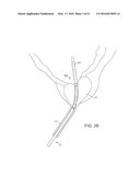 MULTI FLUID TISSUE RESECTION METHODS AND DEVICES diagram and image