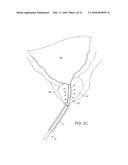 MULTI FLUID TISSUE RESECTION METHODS AND DEVICES diagram and image