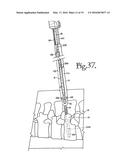 DYNAMIC SPINAL STABILIZATION ASSEMBLIES, TOOL SET AND METHOD diagram and image