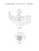 IMPLANTS FOR CREATING CONNECTIONS TO TISSUE PARTS, IN PARTICULAR TO     SKELETAL PARTS, AS WELL AS DEVICE AND METHOD FOR IMPLANTATION THEREOF diagram and image