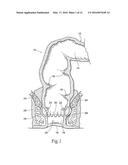 SYSTEMS AND METHODS FOR TREATING DYSFUNCTIONS IN THE INTESTINES AND RECTUM     THAT ADAPT TO THE ANATOMIC FORM AND STRUCTURE OF DIFFERENT INDIVIDUALS diagram and image