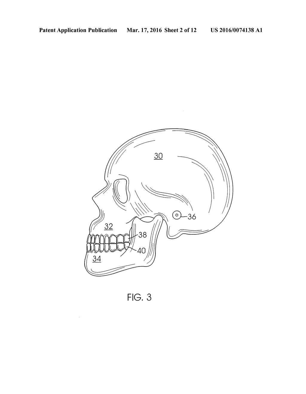 SYSTEM AND METHOD FOR DETECTING DEVIATIONS DURING THE COURSE OF AN     ORTHODONTIC TREATMENT TO GRADUALLY REPOSITION TEETH - diagram, schematic, and image 03