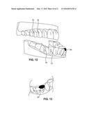SYSTEM AND METHOD FOR DETECTING DEVIATIONS DURING THE COURSE OF AN     ORTHODONTIC TREATMENT TO GRADUALLY REPOSITION TEETH diagram and image