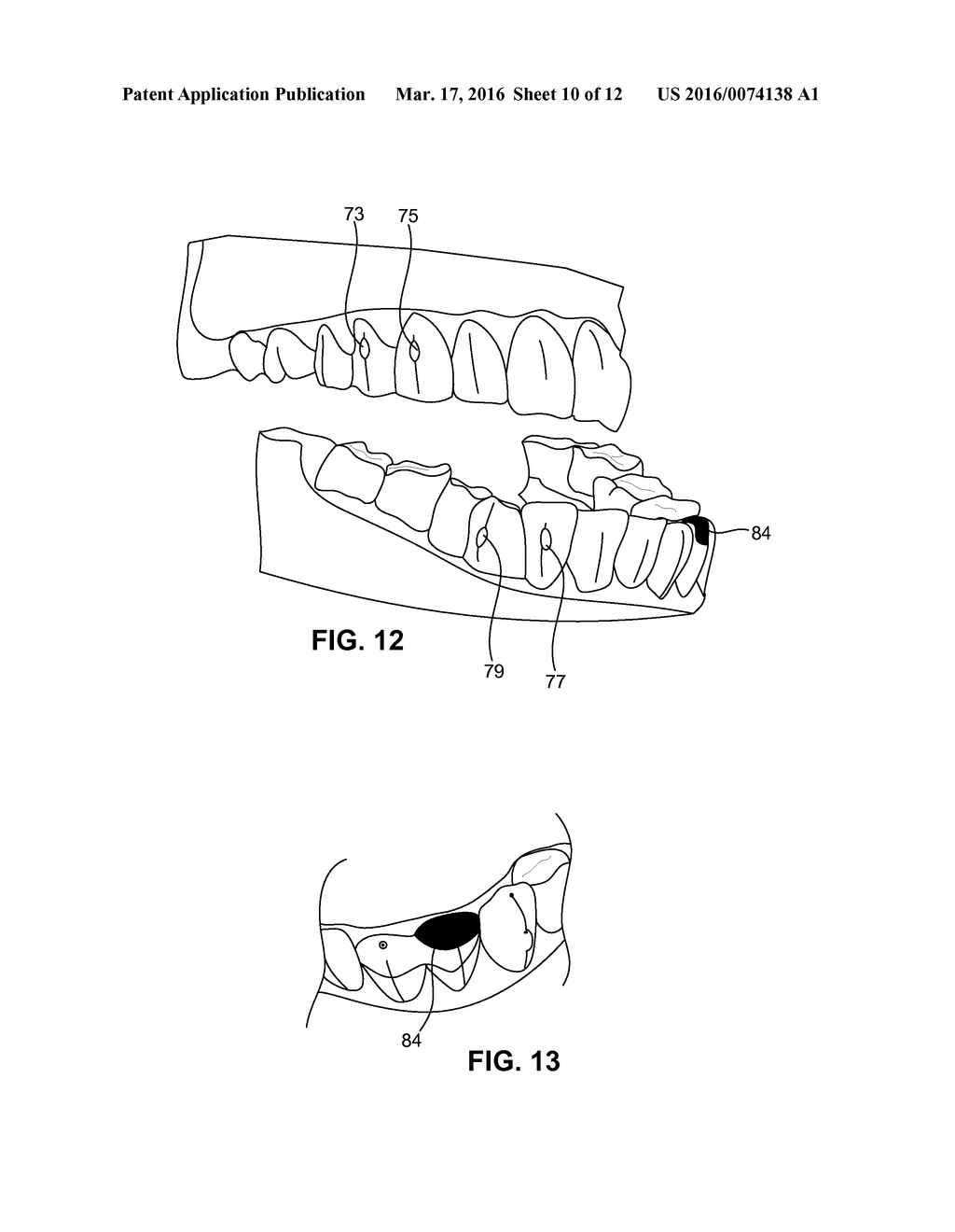 SYSTEM AND METHOD FOR DETECTING DEVIATIONS DURING THE COURSE OF AN     ORTHODONTIC TREATMENT TO GRADUALLY REPOSITION TEETH - diagram, schematic, and image 11