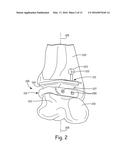 IMPROVED ANKLE REPLACEMENT APPARATUS AND METHOD diagram and image