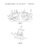 IMPROVED ANKLE REPLACEMENT APPARATUS AND METHOD diagram and image