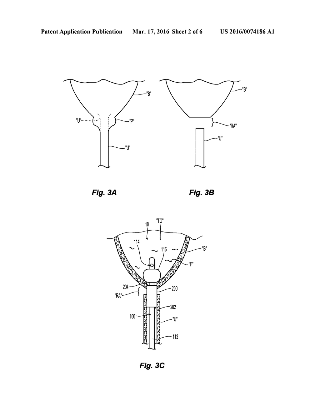 COUPLING A BODY CONDUIT TO TISSUE - diagram, schematic, and image 03