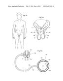 RESTRICTION DEVICE diagram and image