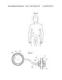 RESTRICTION DEVICE diagram and image