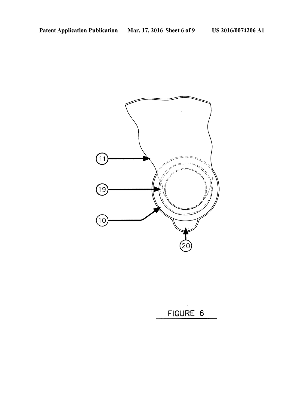 Ostomy appliance removable washable reusable non-adhesive sealing member - diagram, schematic, and image 07