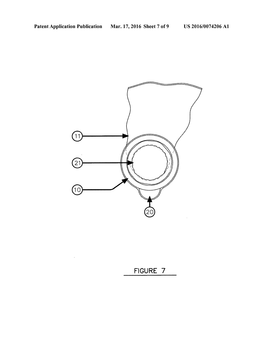 Ostomy appliance removable washable reusable non-adhesive sealing member - diagram, schematic, and image 08