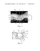 Absorbent Articles diagram and image