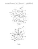 METHODS OF TREATING SPINAL DISORDERS USING AUTOLOGOUS PROTEIN SOLUTIONS diagram and image