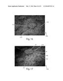 Method Of Making Nonwoven Material Having Discrete Three-Dimensional     Deformations With Wide Base Openings That are Tip Bonded to Additional     Layer diagram and image