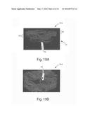 Method Of Making Nonwoven Material Having Discrete Three-Dimensional     Deformations With Wide Base Openings That are Base Bonded to Additional     Layer diagram and image