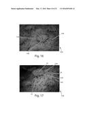 Nonwoven Material Having Discrete Three-Dimensional Deformations That Are     Configured To Collapse In A Controlled Manner diagram and image