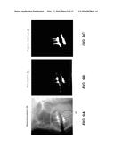 METAL ARTIFACTS REDUCTION IN CONE BEAM RECONSTRUCTION diagram and image