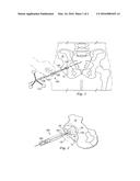 SURGICAL INSTRUMENT TO ASSESS TISSUE CHARACTERISTICS diagram and image