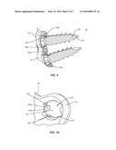 SURGICAL IMPLANT SYSTEM AND METHOD diagram and image