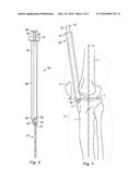 Percutaneous Fixator and Method of Insertion diagram and image
