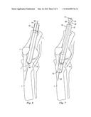 Percutaneous Fixator and Method of Insertion diagram and image