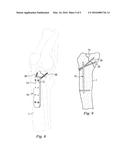 Percutaneous Fixator and Method of Insertion diagram and image